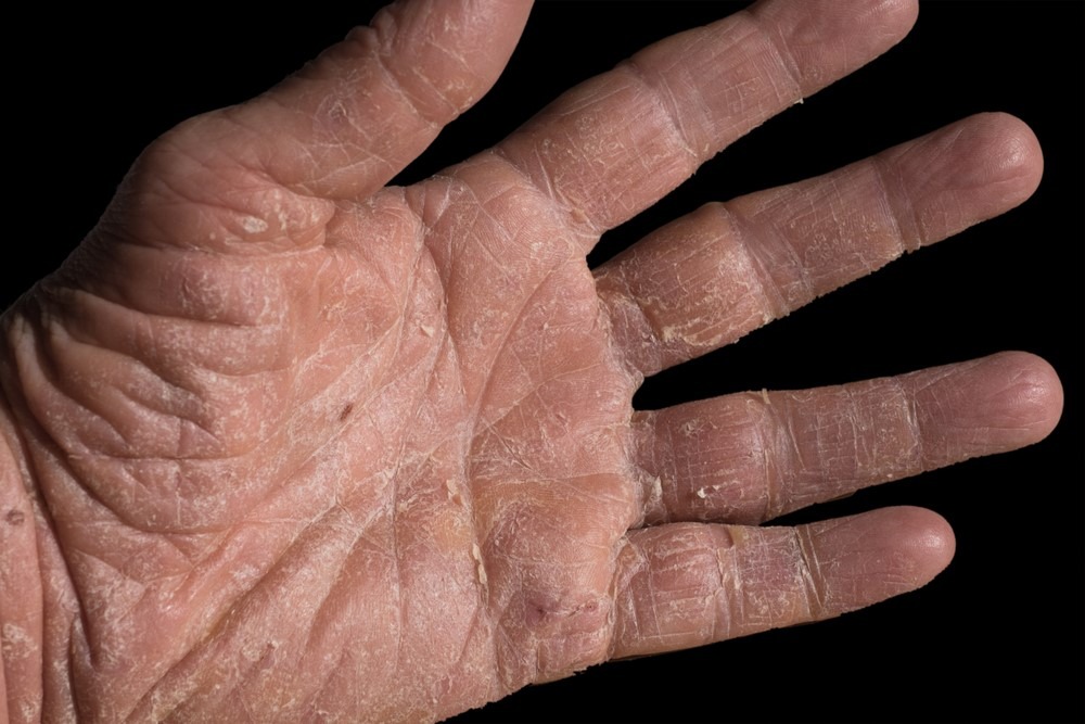 Biểu hiện của bệnh dày sừng ánh sáng là xuất hiện các mảng da khô.