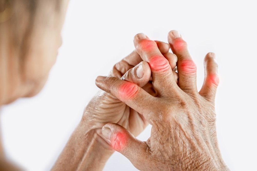  Bệnh gout khiến cho những khớp tay chân sưng đỏ lòe, nhức đớn