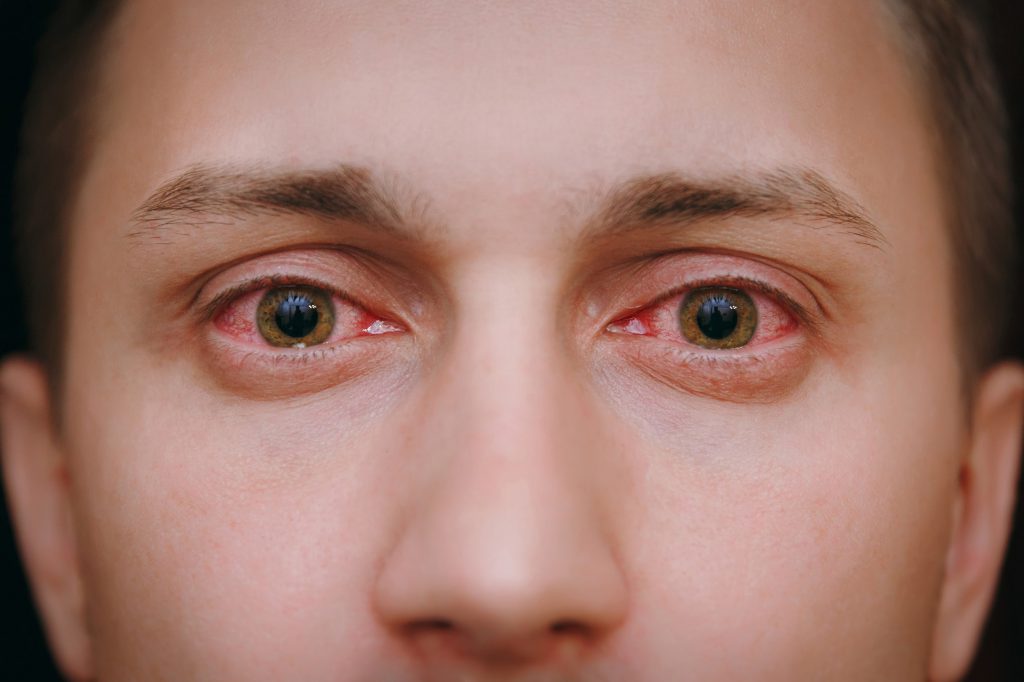 Thuốc nhỏ mắt steroid có tác dụng gì trong việc giảm viêm mộng thịt ở mắt?
