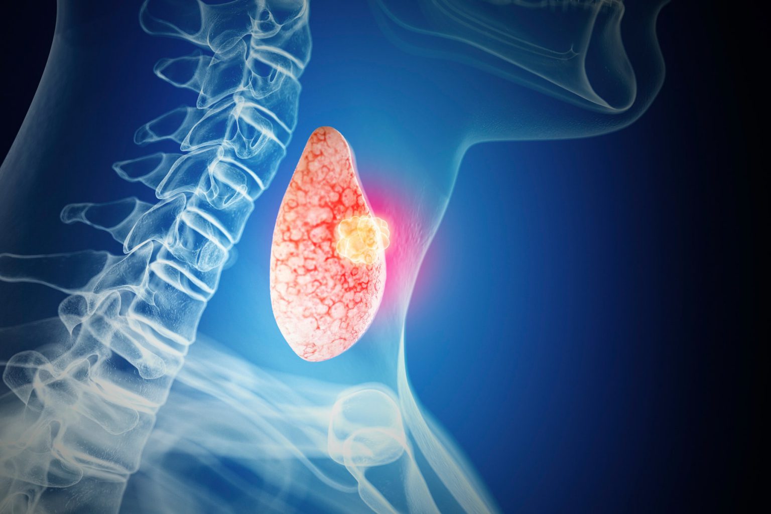 benign-neoplasm-of-thyroid-gland-pacific-cross-vietnam