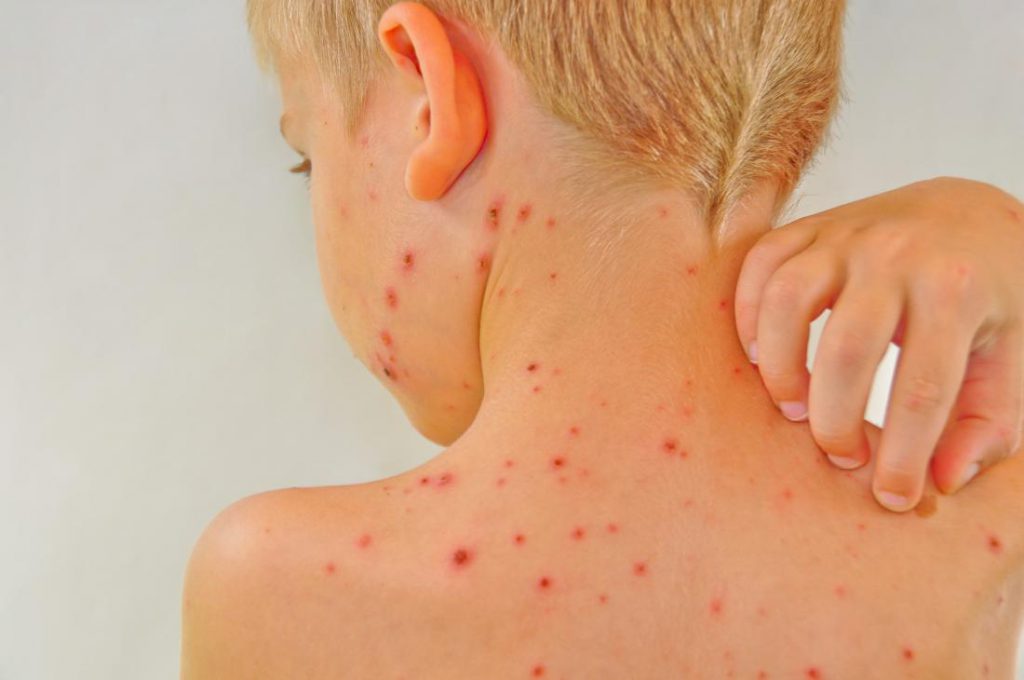 Chickenpox: characteristics, treatments and preventions