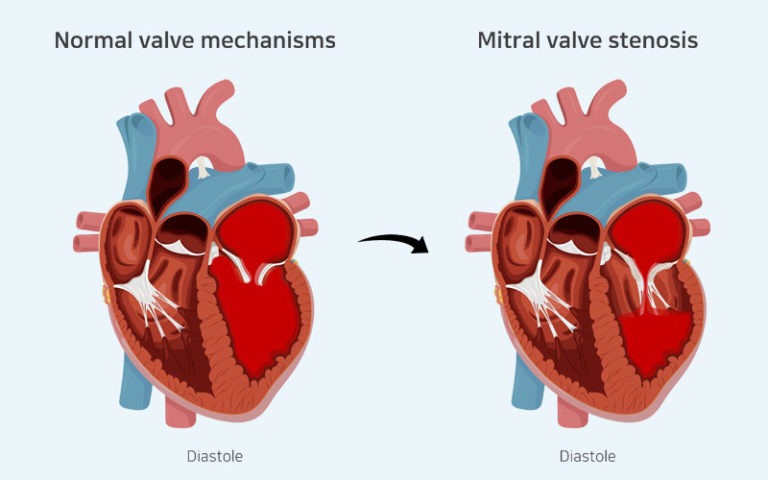 Mitral stenosis - Symptoms and causes | Pacific Cross Vietnam