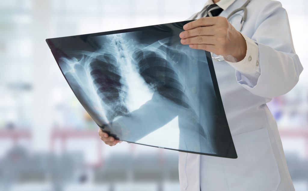 Viêm phổi: Bệnh nhiễm trùng đường hô hấp nguy hiểm