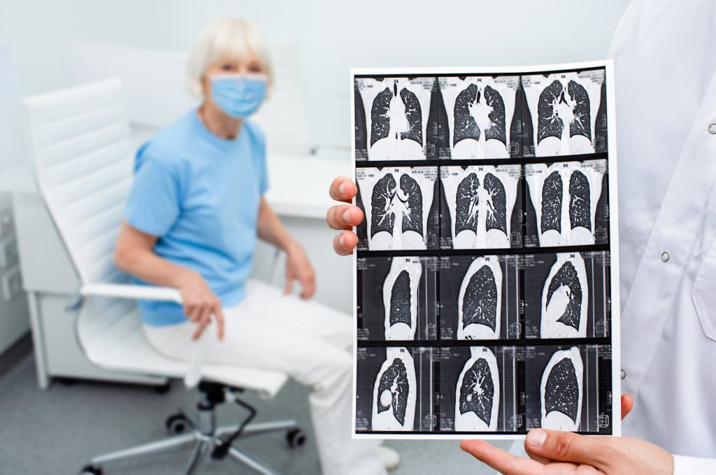 Bác sĩ đưa hình ảnh CT Scan phổi bị xơ hóa cho bệnh nhân lớn tuổi xem.
