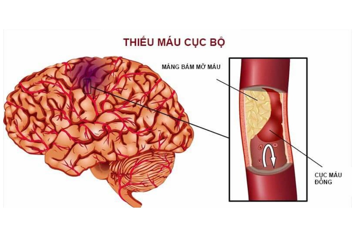 Quả mọng như nho, dâu tây có tác dụng gì trong việc trị thiếu máu não?

